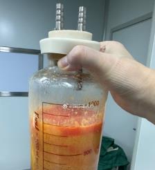 克拉玛依水动力吸脂手术要做多久？
